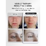 Red Light Therapy Face Mask