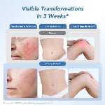 Silicone Pdt Led Light Therapy Device