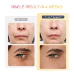 RF Skin Tightening Device